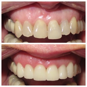 antes y después de la sonrisa foto de la galería