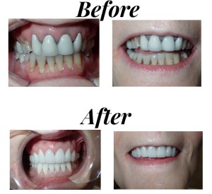 antes y después de la sonrisa foto de la galería